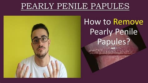 papule perlee penis|Penile Papules: What Are They and How Do They。